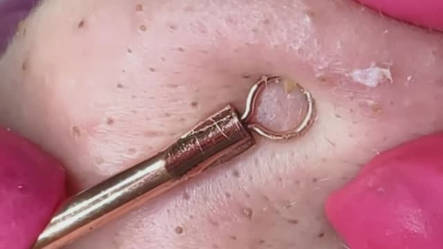 Чистка лица от прыщей и черных точек