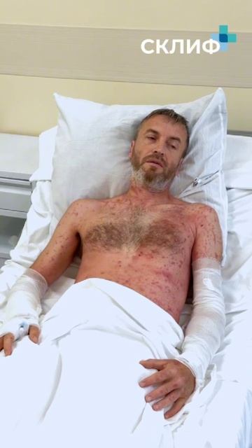 Врачи показали, чем заканчивается контакт с борщевиком: мужик косил траву и получил химические ожоги