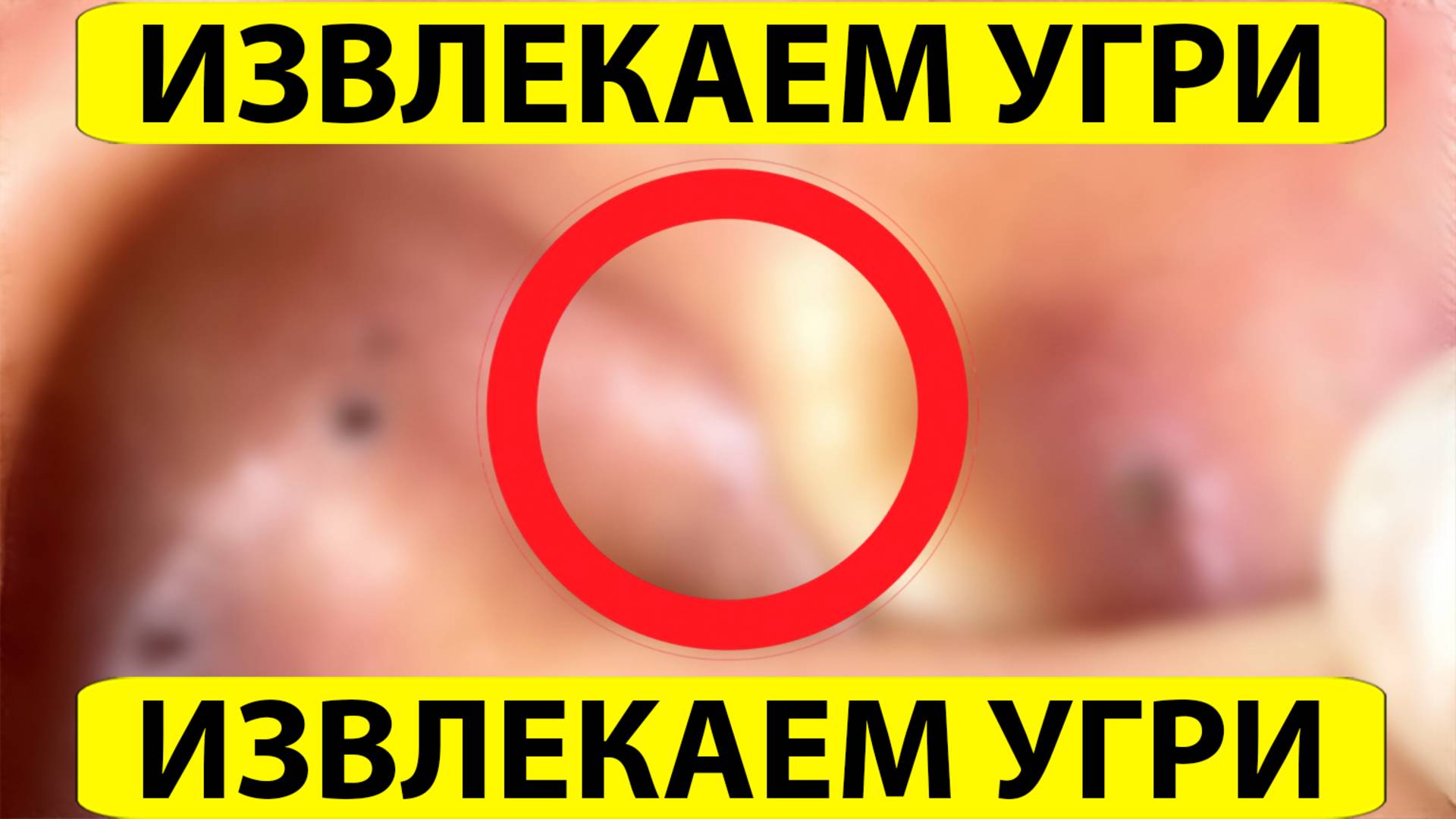 Удаление черных точек. Выдавливание прыщей. Акне и комедоны. Чистка Лица.