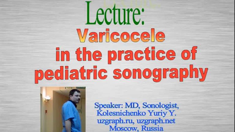 Varicocele in a child sonography