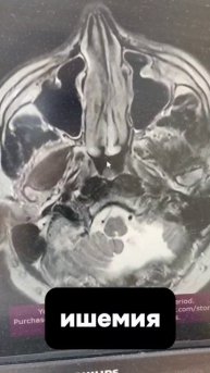 Инсульт бывает разным. Какой тип инсульта хотите разобрать?