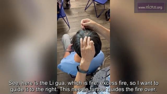 Bagua_Scalp_Acupuncture_for_Hypertension_八卦头针治疗高血压_by_宋文靖中醫師_Dr