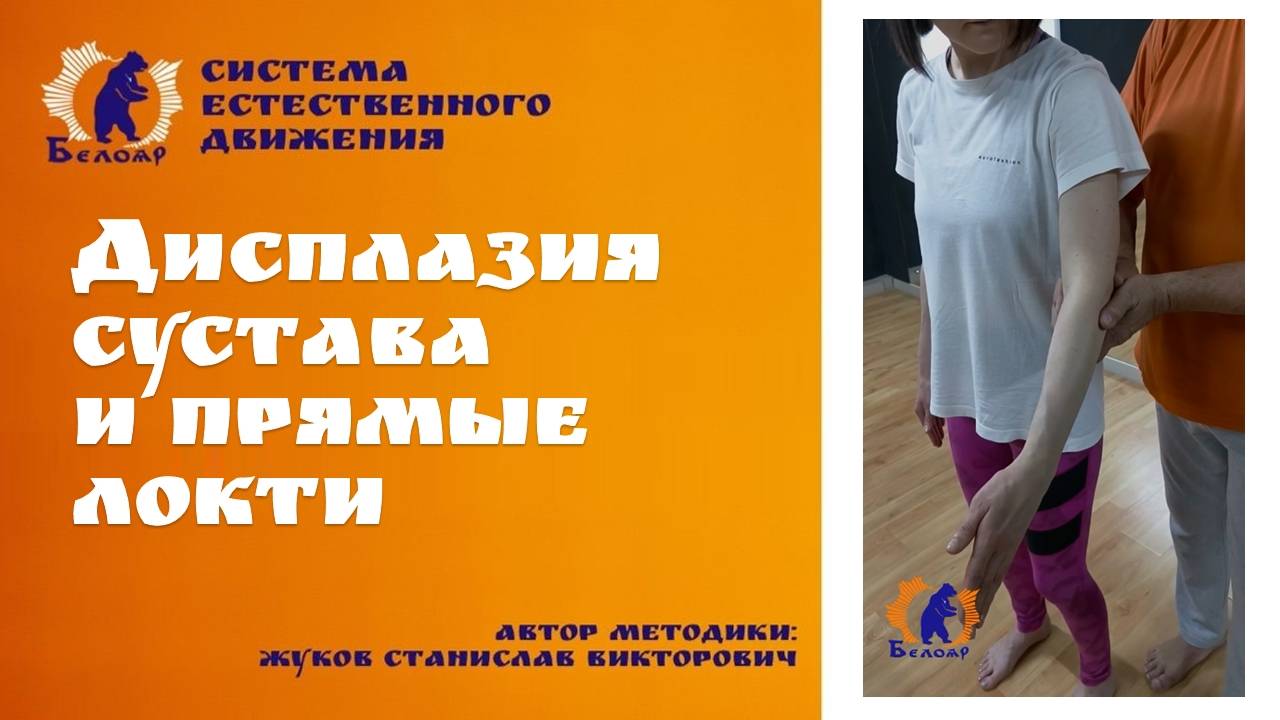 Дисплазия сустава и прямые локти