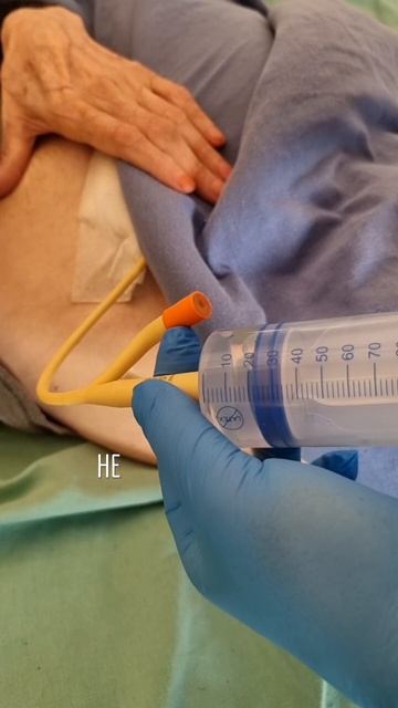 Как промывать цистостому? Самый популярный вопрос при выписке из больницы.