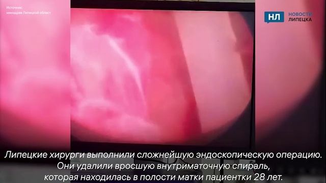 Контрацептив намертво врос в тело липчанки за 28 лет
