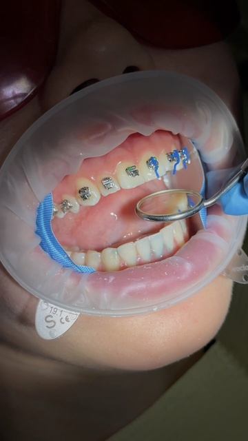🔥 Старт красивой улыбки с Fresh Dental!