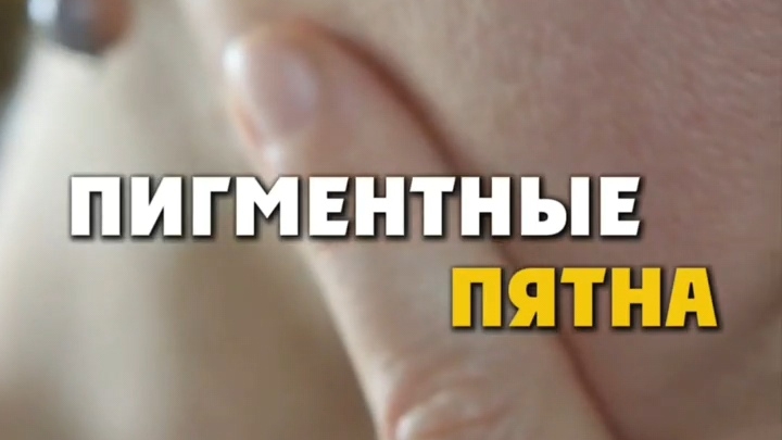 Пигментные пятна
