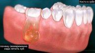 Почему своевременно надо лечить зуб