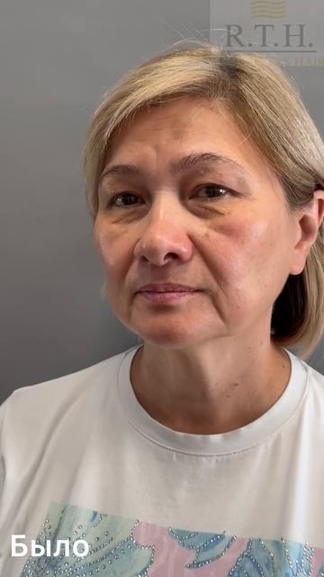 Неделя после верхней и нижней блефаропластики!