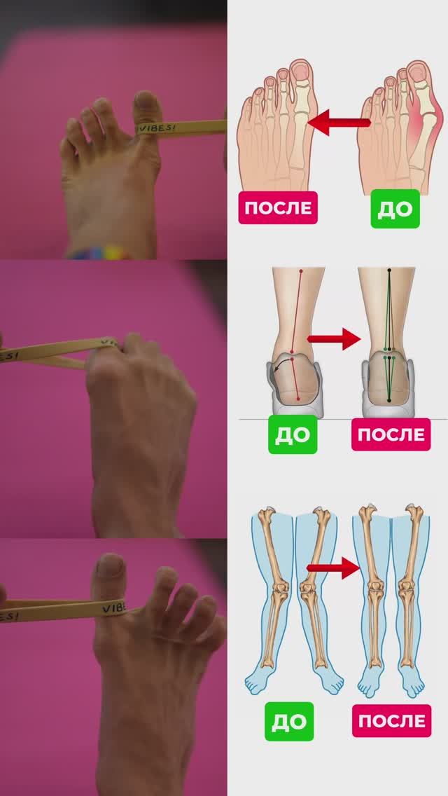 Избавляемся от вальгуса. Подпишись и читай описание ✅
