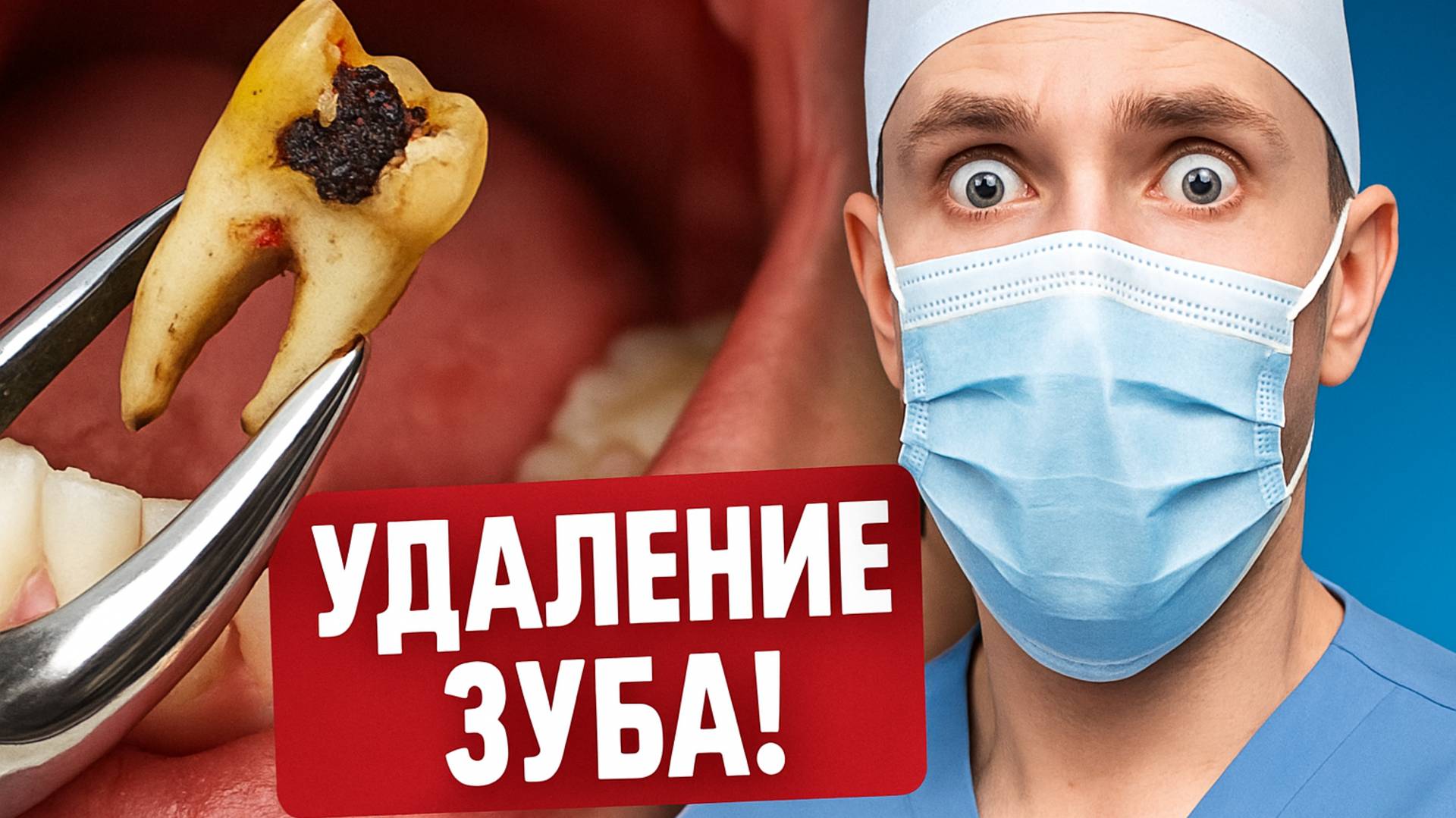 Удаление ЗУБА МУДРОСТИ, безболезненное удаление зуба мудрости. Без зуба мудрости будешь мудрее