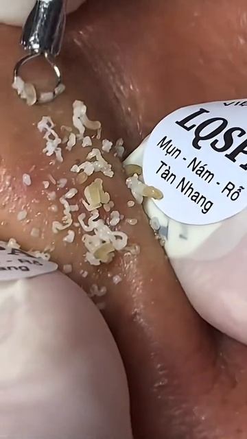 Акне, Прыщи, Комедоны