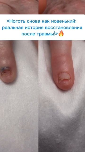 🔥 История восстановления ногтя после травмы 🔥