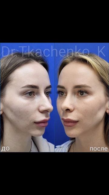 Комплексная операция: ринопластика, увеличение подбородка (костная пластика) + увеличение углов