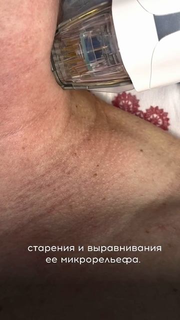 Микроигольчатый RF-ЛИФТИНГ 
поможет восстановить качество и эластичность кожи быстро и эффективно!