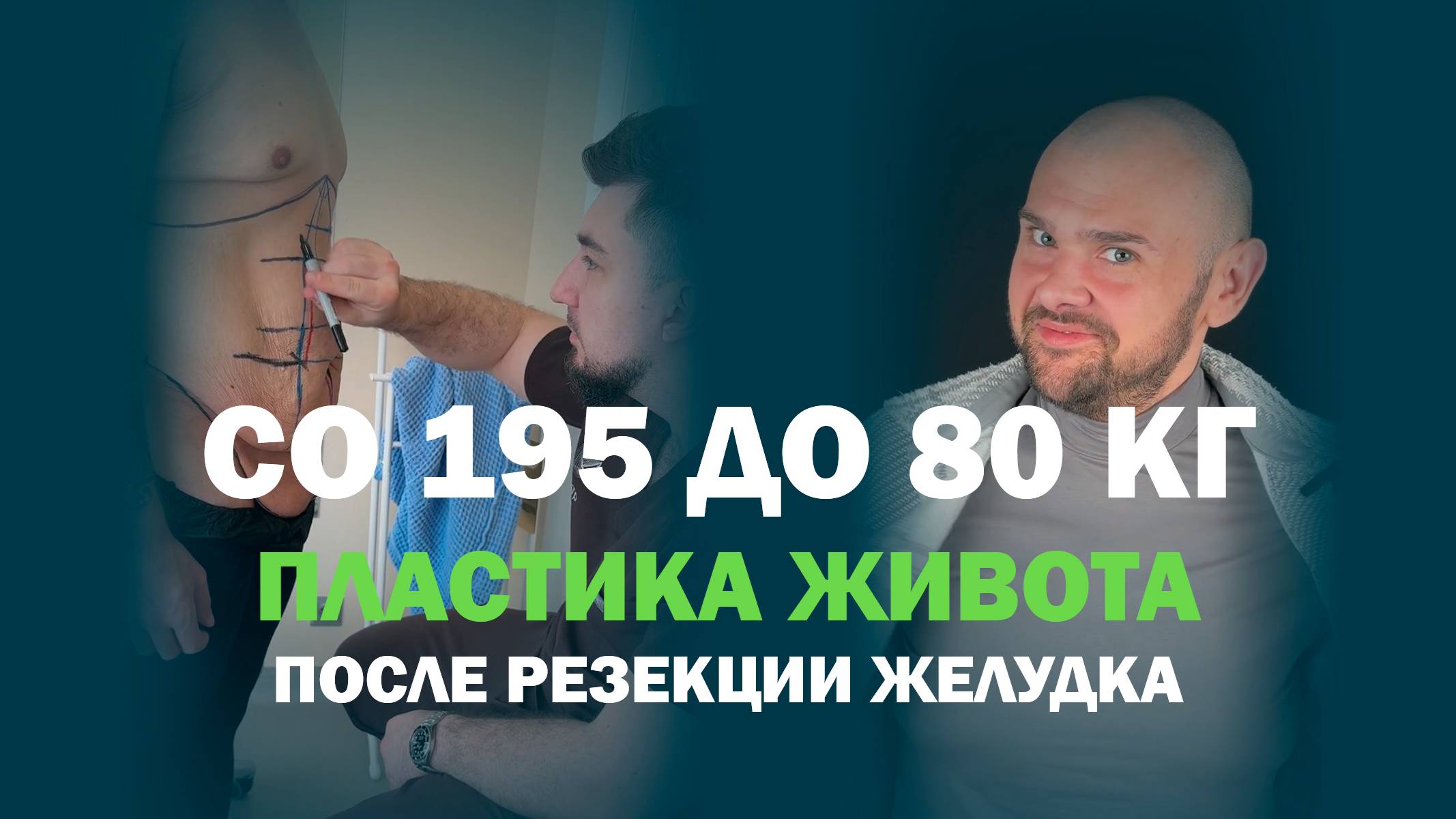 Мужская история после резкого похудения: пластика живота и липосакция