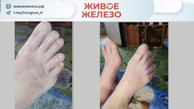 Трофические нарушения на ногах, стопа курильщика, микроциркуляция и Живое Железо для восстановления