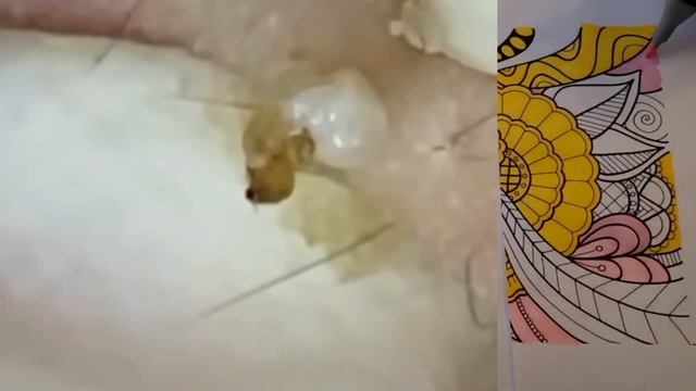 Механическая чистка лица