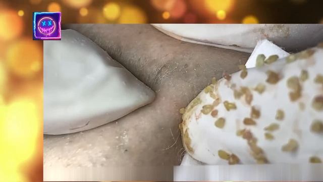Выдавливание прыщей и угрей
