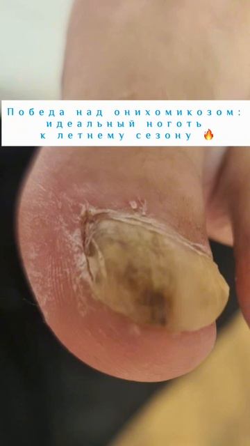 Как восстановить поврежденные ногти , пишу на канале телеграмм https://t.me/svetlana_pedicure