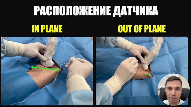 PENG block
#узинавигация #regionalanesthesia #лечениеболи #PENG #курсыузи #практикум #painmanagment