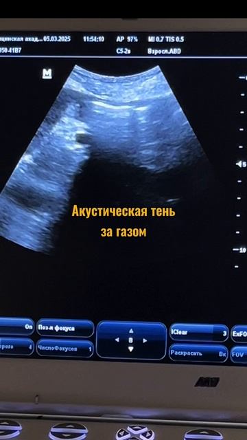 УЗИ ЖЕЛУДКА И ОЦЕНКА РИСКА АСПИРАЦИИ
#узижелудка #gastricultrasound