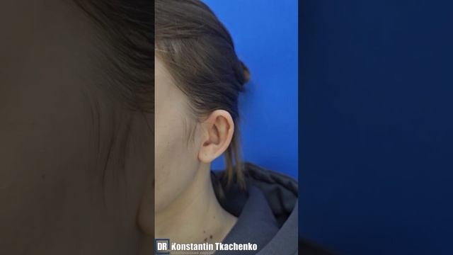 Девушке 18 лет приехала ко мне на операцию из Мордовии.