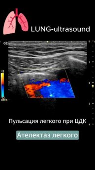 ОБТУРАЦИОННЫЙ ТОТАЛЬНЫЙ АТЕЛЕКТАЗ
#ICU #ОРИТ #реанимация #узилегких #ателектаз