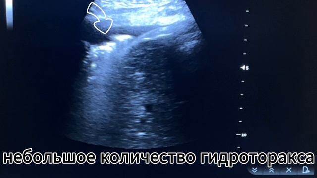 BLUE-протокол. Исследование в PLAPS-точке. Пневмония
#ОРИТ #ICU #реанимация #УЗИ  #пневмония