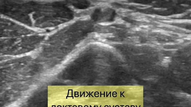 ВАРИАНТЫ СТРОЕНИЯ СРЕДИННОГО НЕРВА #узи #нервов