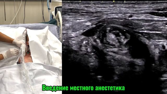 ПОДКЛЮЧИЧНАЯ БЛОКАДА ПЛЕЧЕВОГО СПЛЕТЕНИЯ
#painmanagment #узинавигация #regionalanesthesia #курсы