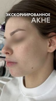Экскориированные акне