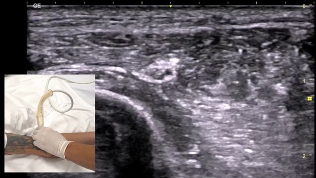 БЛОКАДА ЛУЧЕВОГО НЕРВА в нижней трети плеча. Медиальный доступ
#painmanagment #узинавигация
