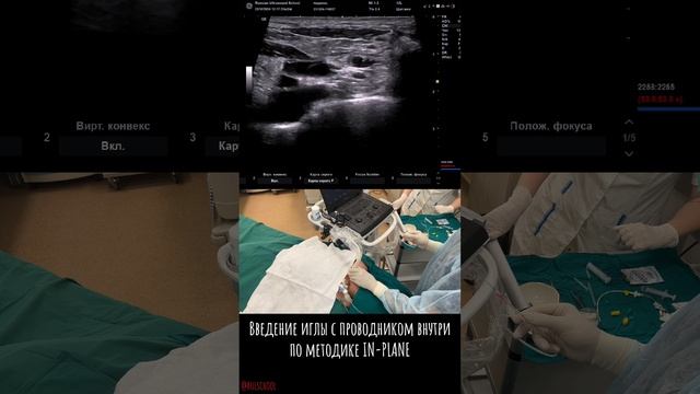 КАТЕТЕРИЗАЦИЯ ПОДКЛЮЧИЧНОЙ ВЕНЫ НАДКЛЮЧИЧНЫМ ДОСТУПОМ
#узинавигация #сосудистыйдоступ #надклюк