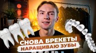 Снова брекеты. Наращиваю зубы
