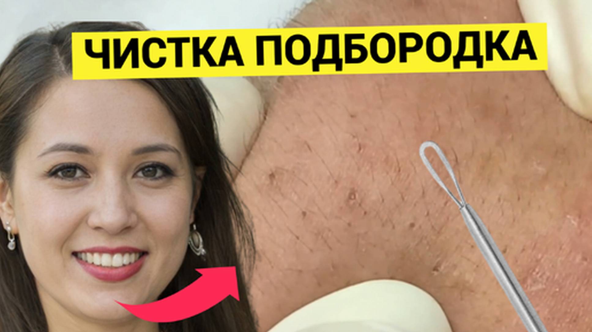 Подбородок девушки в Комедонах и Черных точках. Обзор косметологической очистки кожи