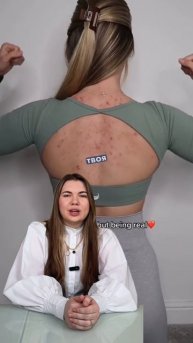 Высыпания на спине
Ухаживаем правильно