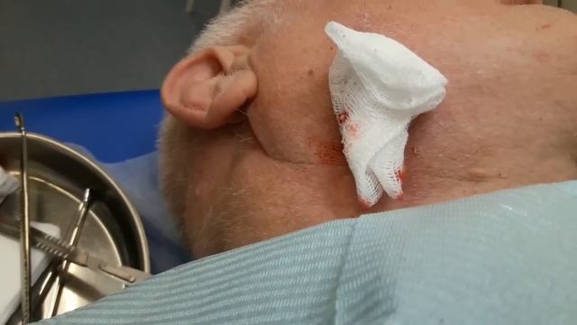 Нагноение жировика на лице операция