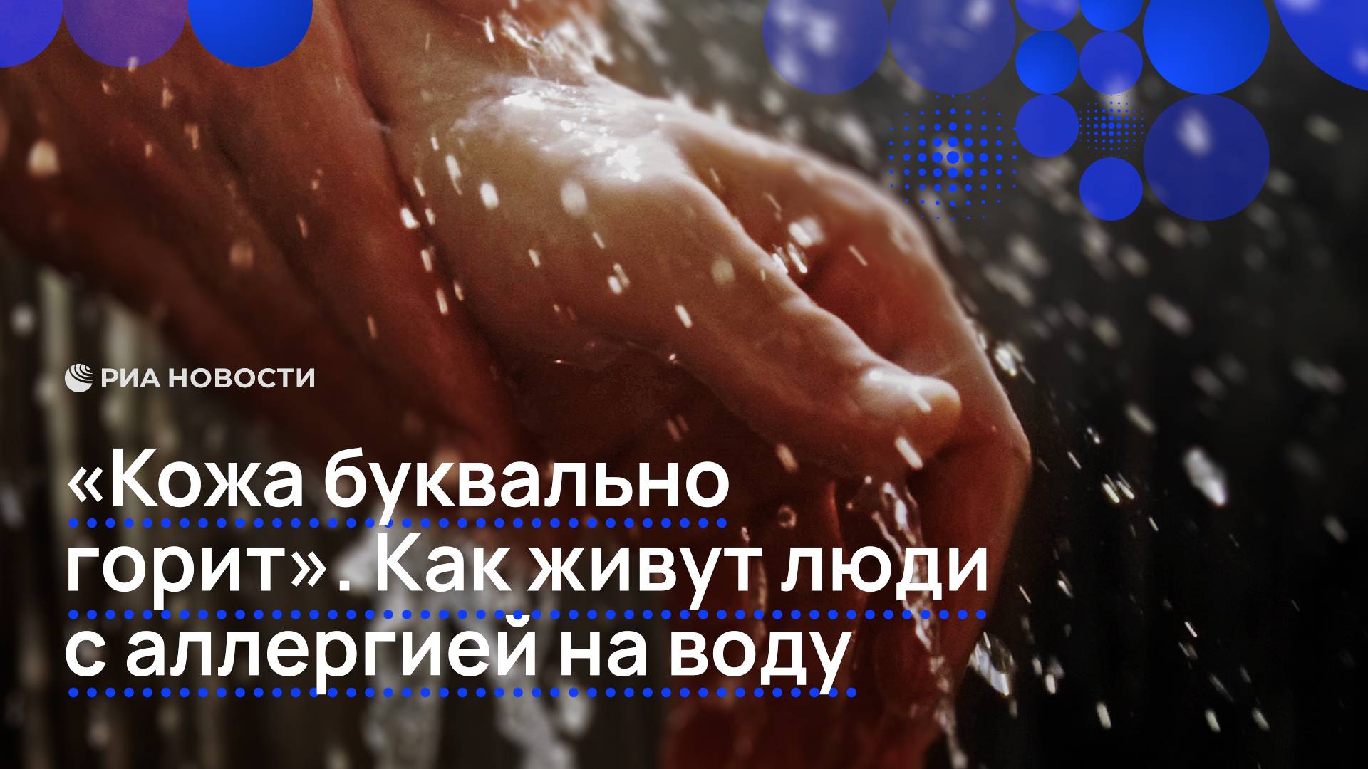 "Кожа буквально горит". Как живут люди с аллергией на воду