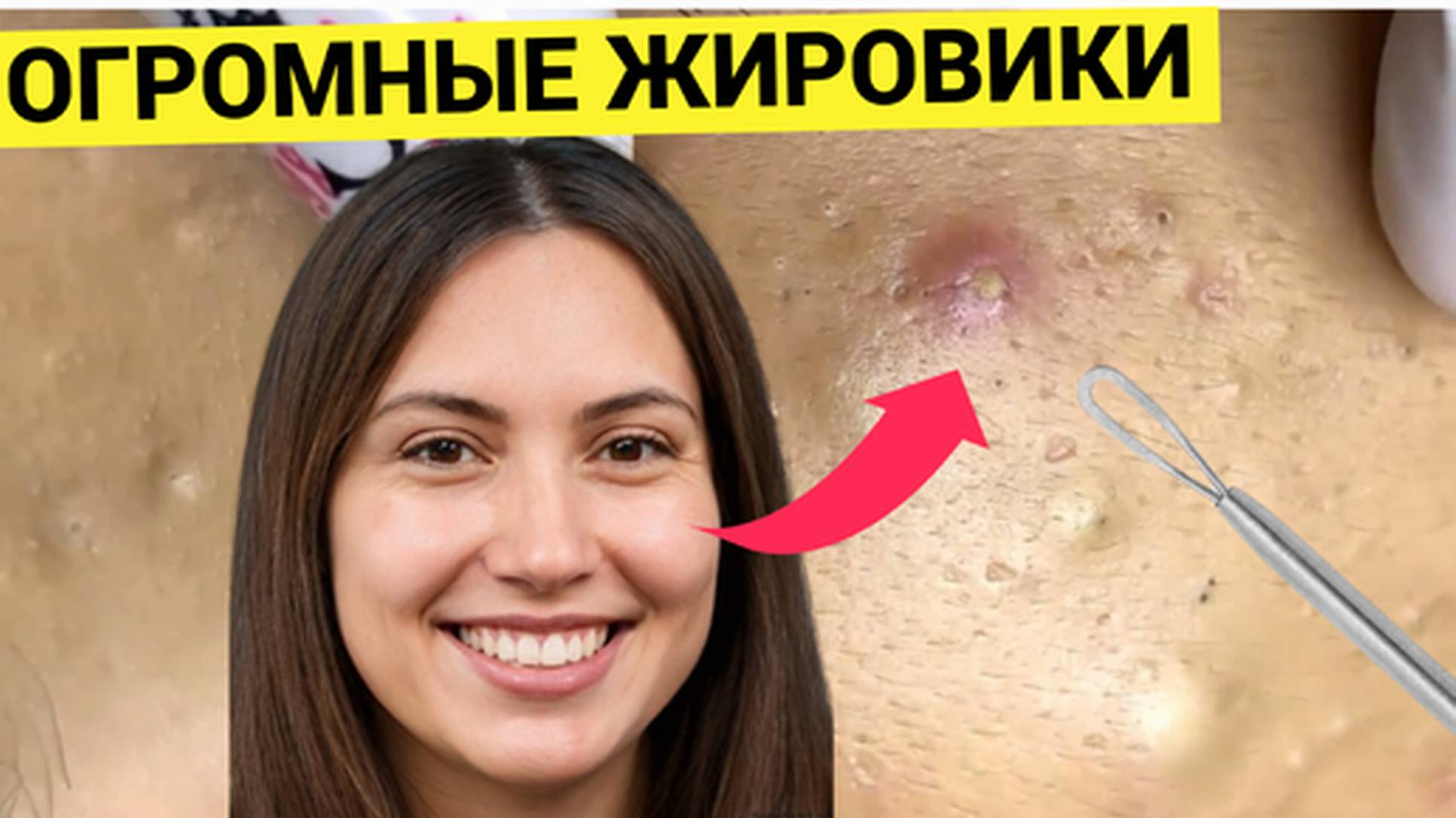 Накопила Огромные Жировики и Прыщи Подкожные. Косметолог выручает. Хорошо всё сделал