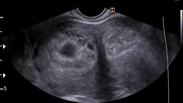 Двурогая матка, беременность 8 недель УЗИ.