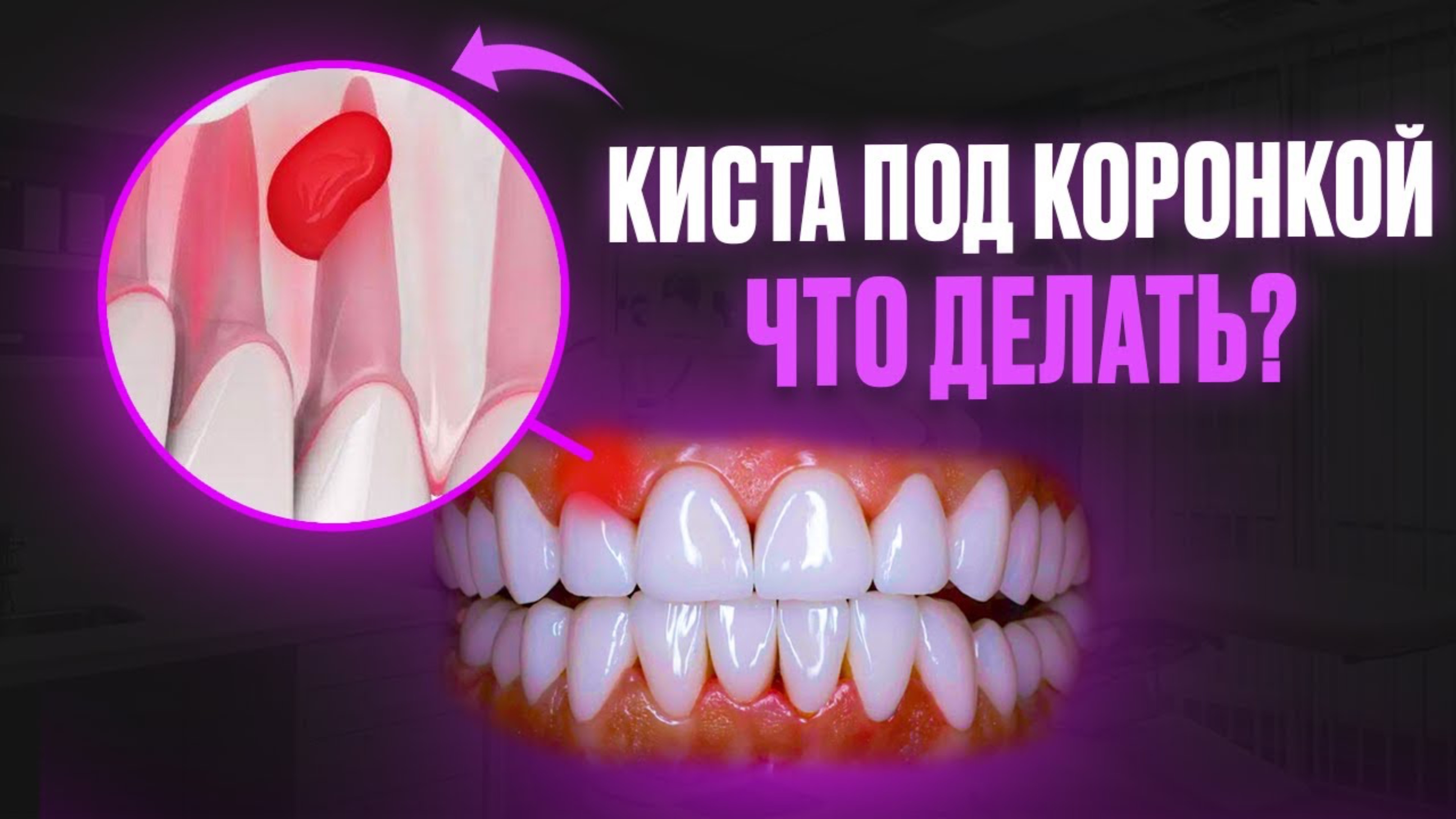 КИСТА ПОД КОРОНКОЙ ЗУБА? ПОСЛЕДСТВИЯ И ЧТО ДЕЛАТЬ?