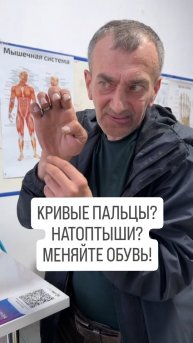 Почему пальцы искривились и стали молоткообразными? #плоскостопие #кривыепальцы #натоптыши #вальгус