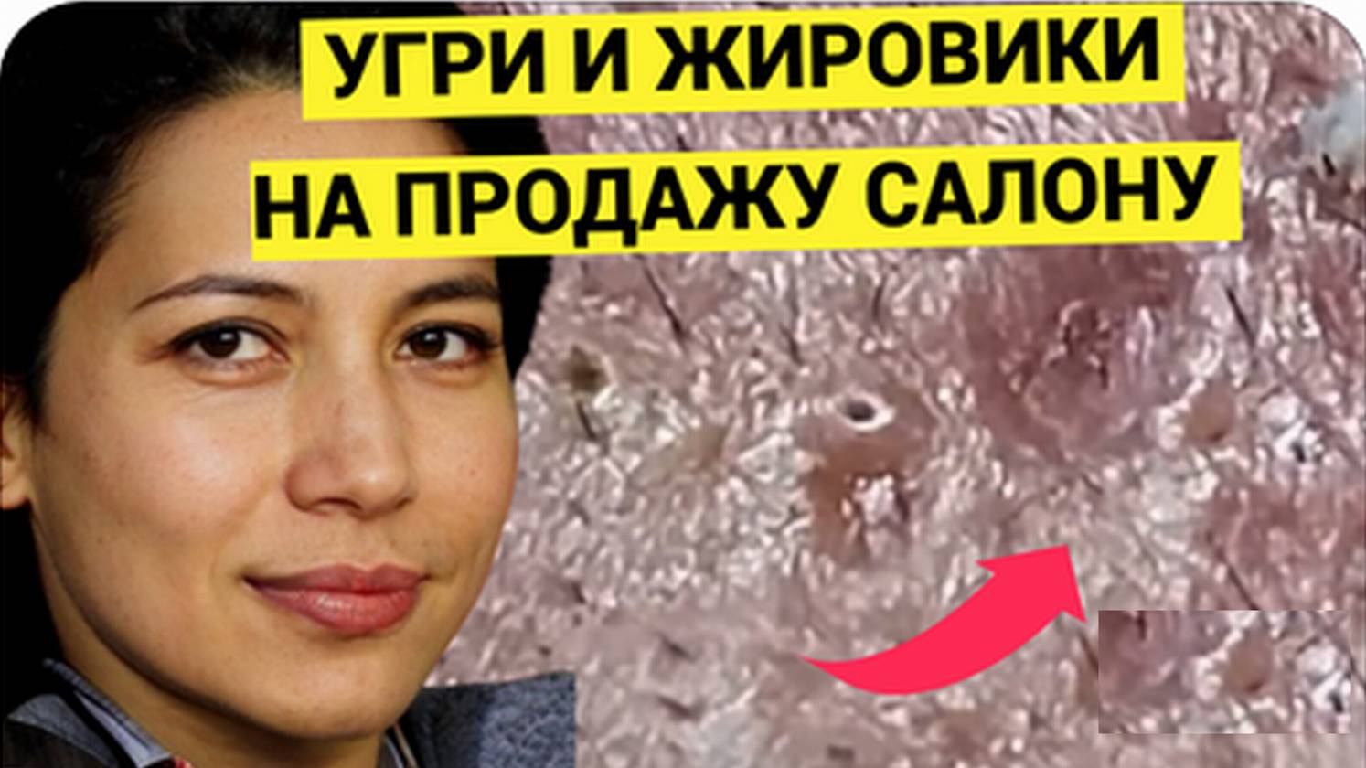Акне на ПРОДАЖУ. Он ВЫРАСТИЛ Жировики и Прыщи для этого Выдавливания. Приглашенный Гость у Косметоло
