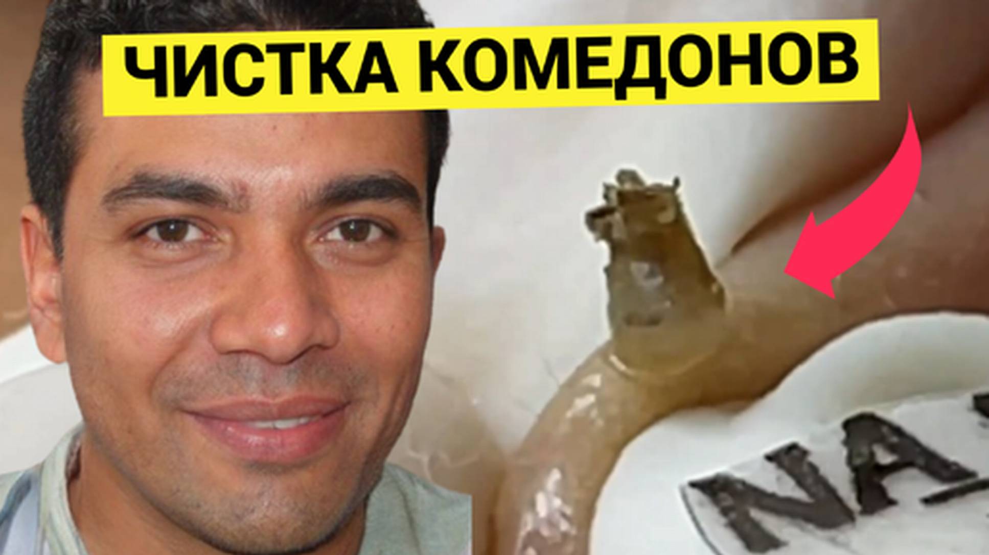 Большой Жировик прямо под Родимым Пятном. Косметологу пришлось быть особенно аккуратным, но всё полу