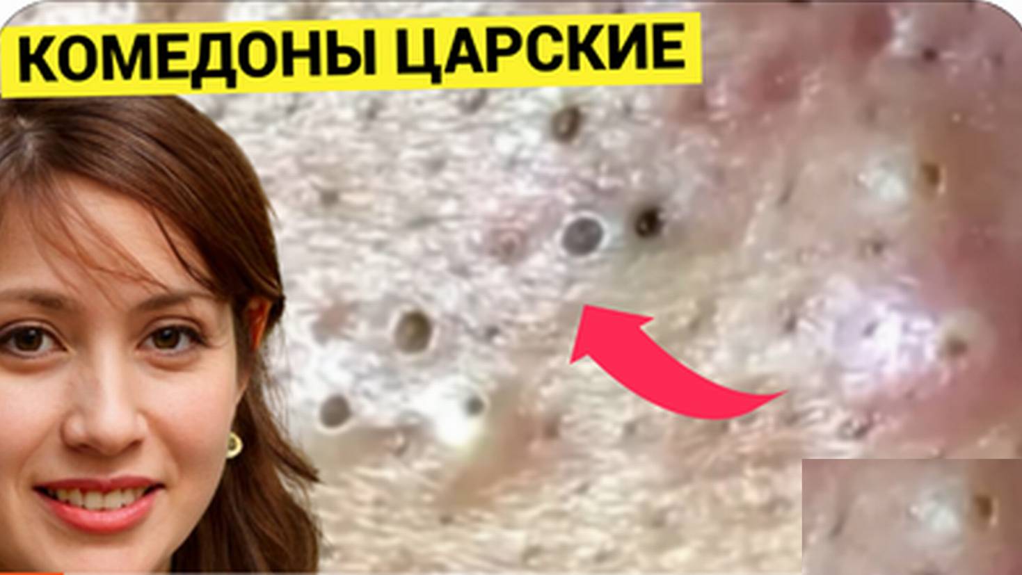 Мастер-класс по Выдавливанию Обалденных Прыщей и Комедонов. Пригласили звезду Гостя и специального К
