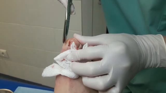 Операция по удалению вросшего ногтя