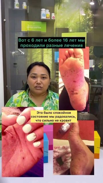 КАК ВЫЛЕЧИТЬ ПСОРИАЗ?
