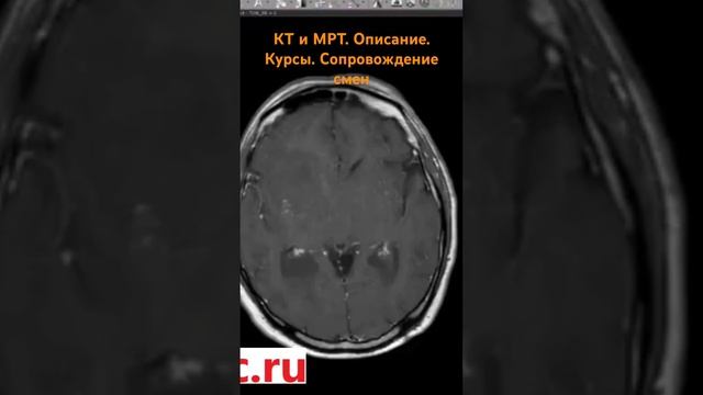 Потерял сознание. Что на МРТ?