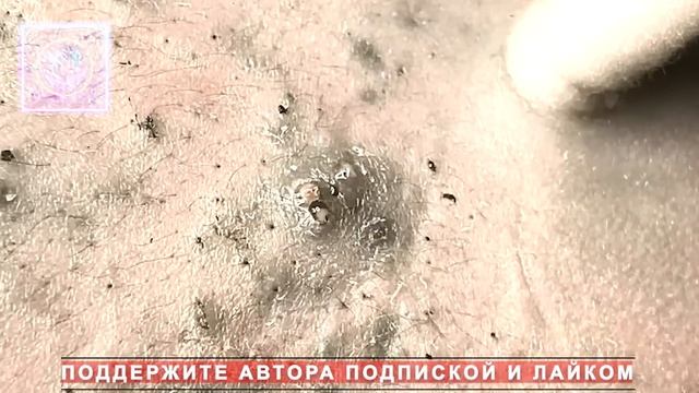 Извлечение угрей и прыщей. Черные точки. Удаление угрей и выдавливание прыщей на лице и теле